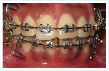 metal rubber bands for braces